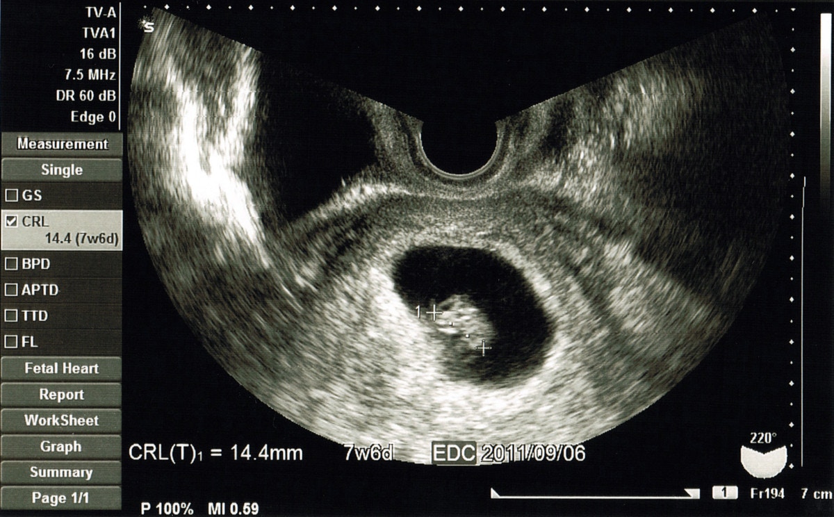 胎嚢の平均的な大きさとは 時期ごとの大きさの目安や体験談も紹介 ママリ