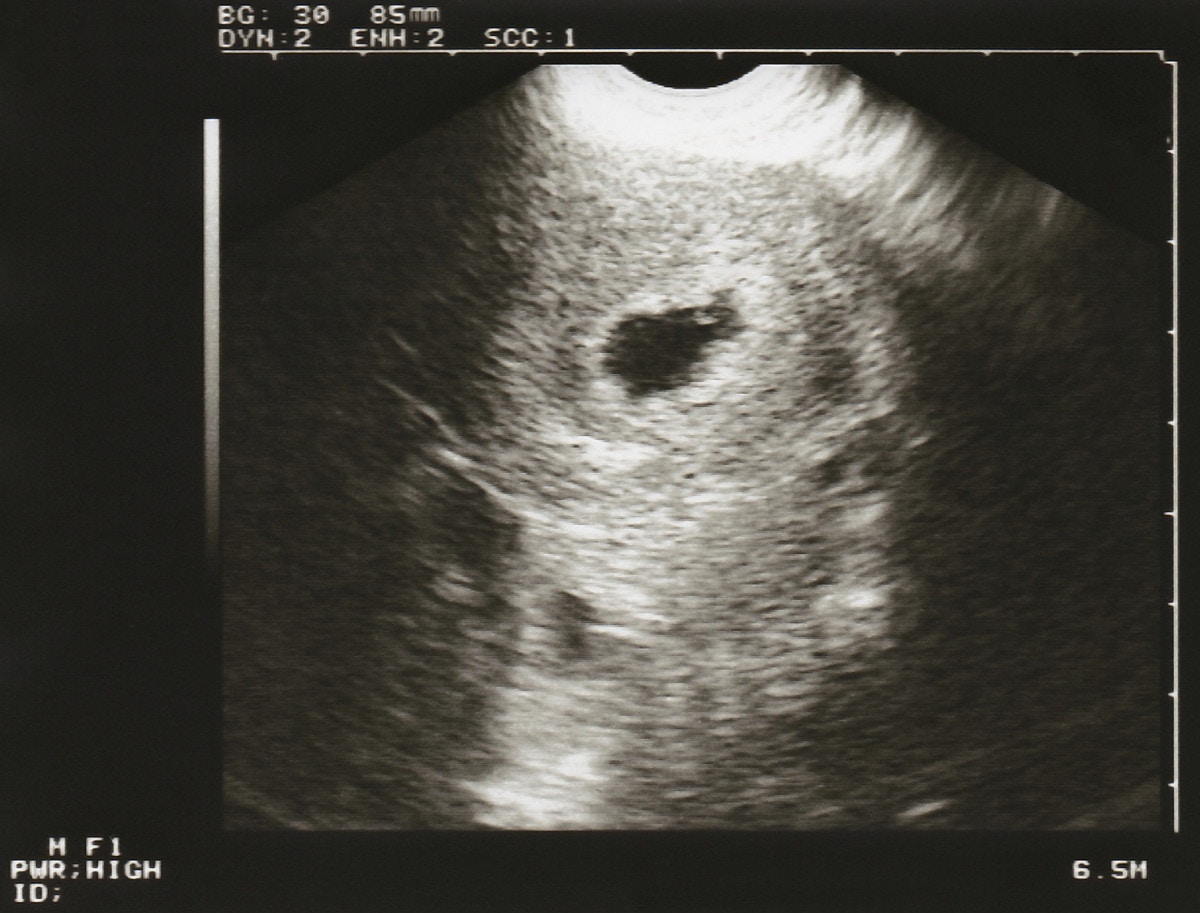医療監修 胎嚢 たいのう とは 確認方法や確認できる時期を知ろう ママリ