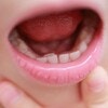 永久歯が乳歯の内側から生えるのは大丈夫？受診が必要なケースとは？