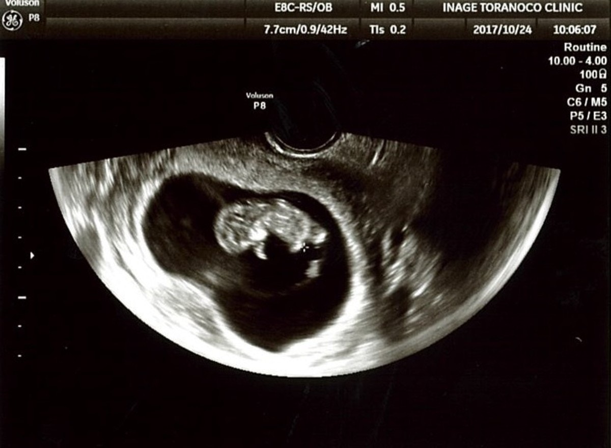 怀孕10周胎儿真实图片-菠萝孕育