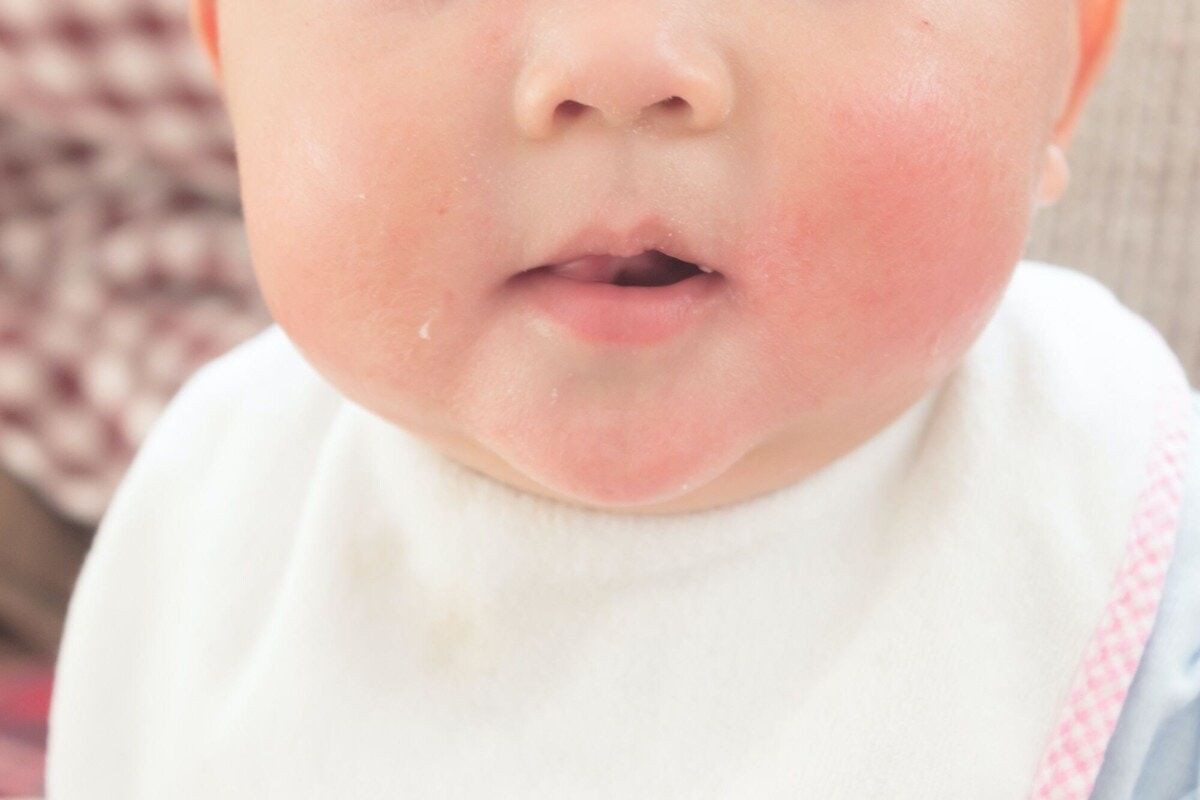 離乳食で注意したい食物アレルギー 対応の進め方やレシピの工夫を解説 ママリ 離乳食で注意したい食物アレルギー 対応の進め方やレシピの工夫を解説 ママリ