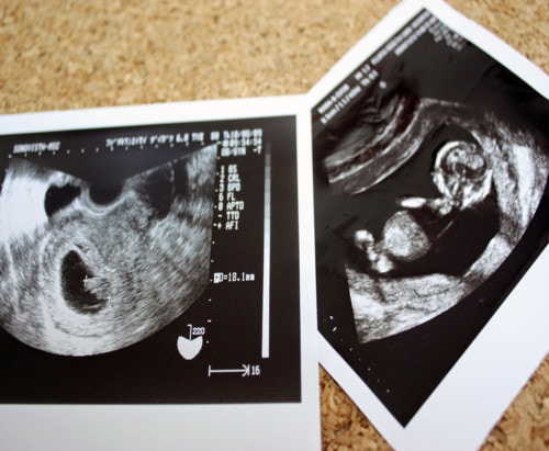 75 妊娠 8 週 小さい 画像ブログ