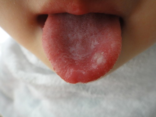 医療監修 子供が訴える口の中の痛みはどのような病気が考えられる ママリ