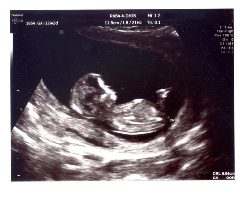 医療監修 エコー写真を妊娠の経過別に紹介 写真の見方や性別の見分け方 ママリ
