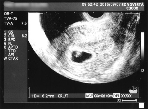 医療監修 エコー写真を妊娠の経過別に紹介 写真の見方や性別の見分け