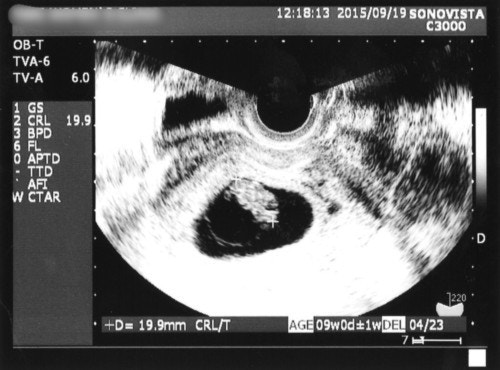 2ページ目 医療監修 エコー写真を妊娠の経過別に紹介 写真の見方や性別の見分け方 ママリ