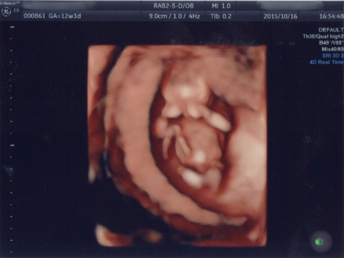 3ページ目 医療監修 エコー写真を妊娠の経過別に紹介 写真の見方や性別の見分け方 ママリ