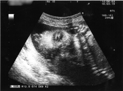 4ページ目 医療監修 エコー写真を妊娠の経過別に紹介 写真の見方や性別の見分け方 ママリ