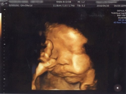医療監修 エコー写真を妊娠の経過別に紹介 写真の見方や性別の見分け方 ママリ